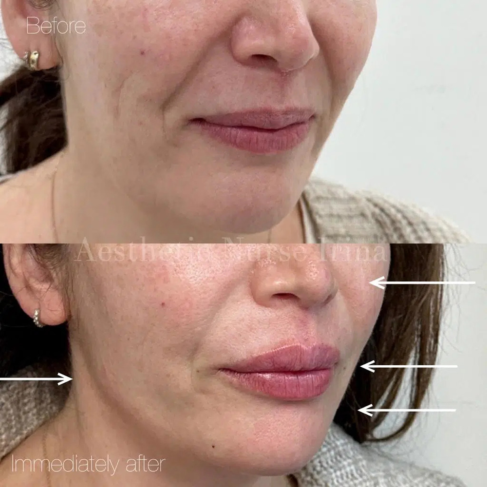 marionette lines treatment, lower face volume loss, skin structure support