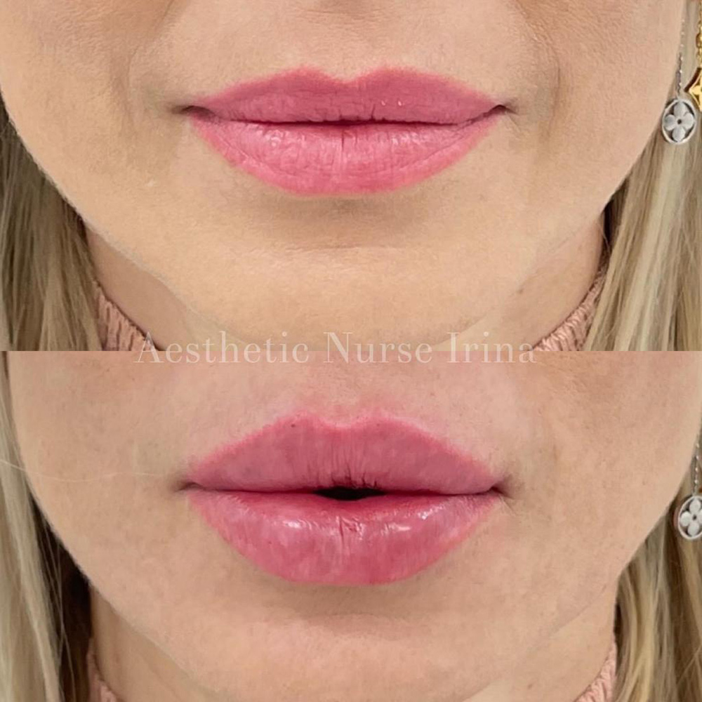 uneven lips, lip asymmetry, upper lip imbalance, lip shape