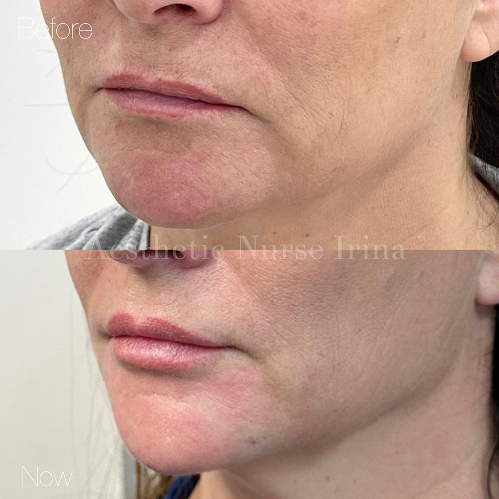 uneven upper lip, lip reshaping, lip correction, cosmetic lip treatment