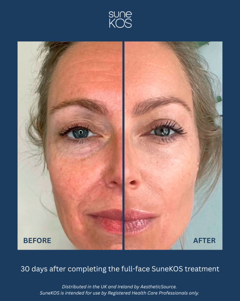skin bioregeneration treatment, skin regeneration treatment, collagen stimulation treatment, skin rejuvenation treatment